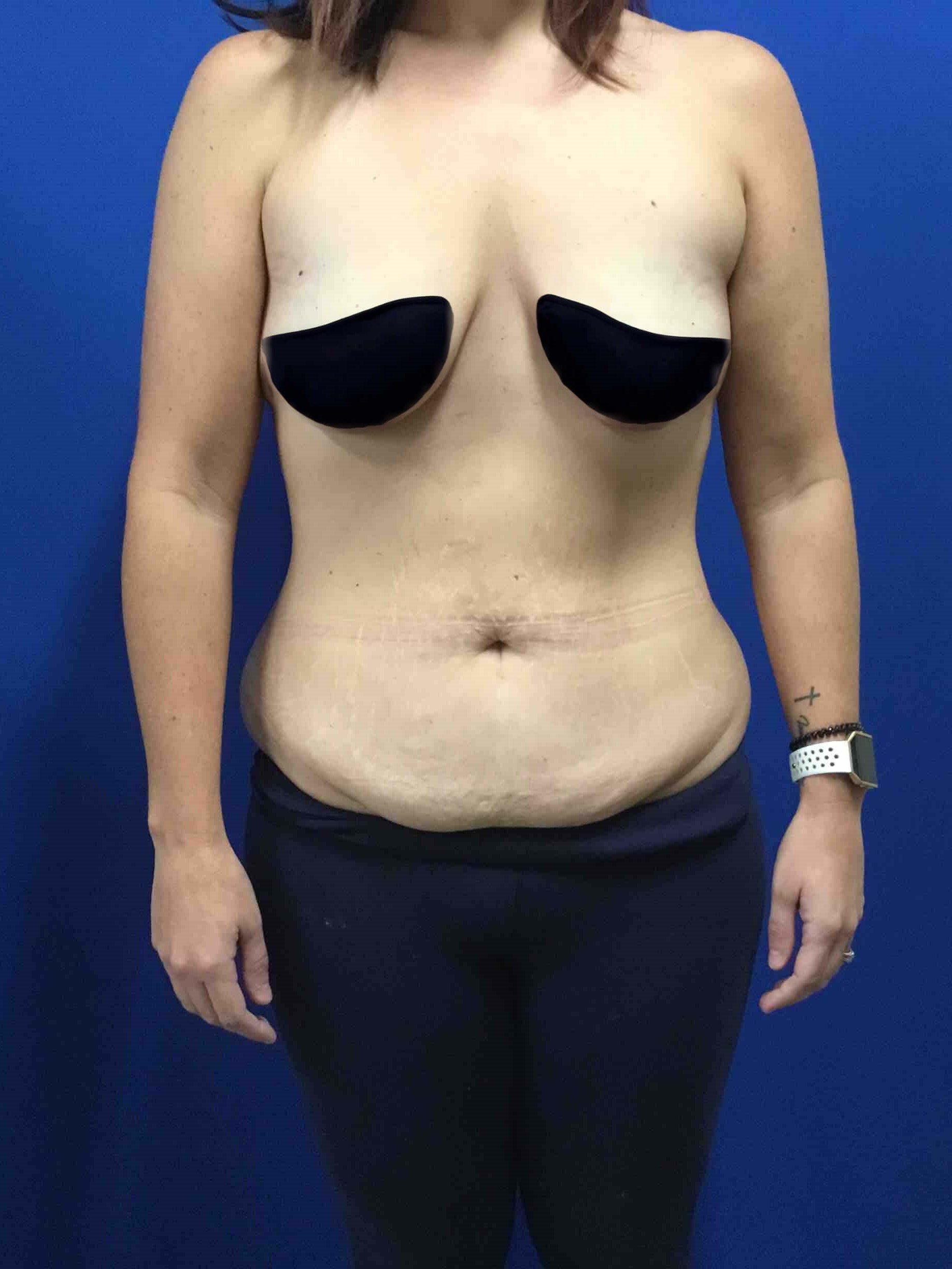 Lower bodylift Before