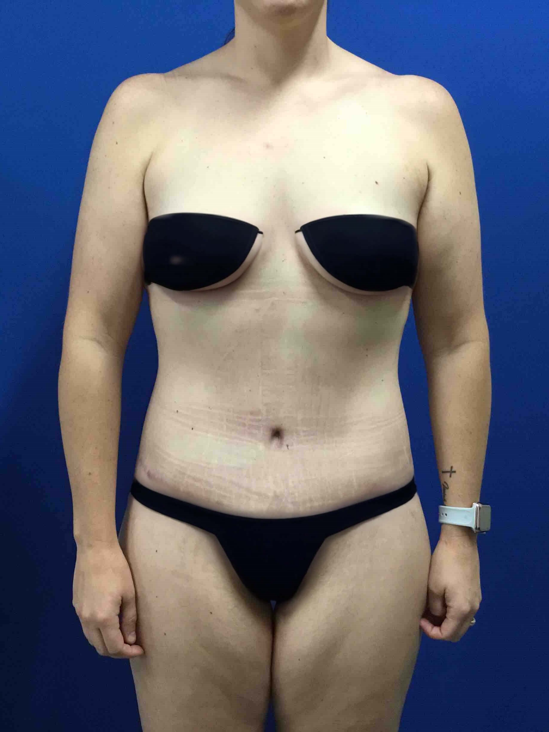 Lower bodylift After