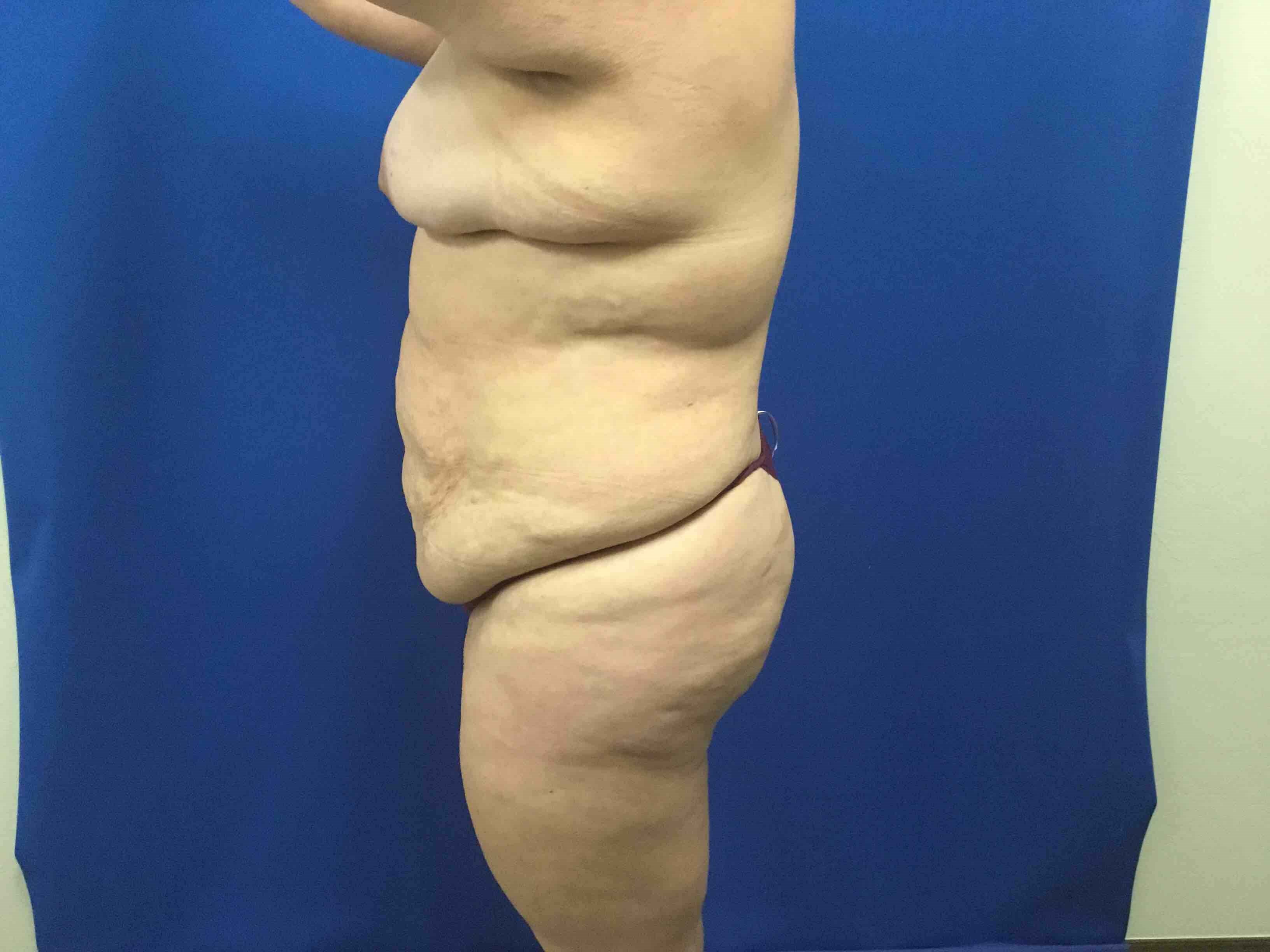 Side View-3D Abdominoplasty Before