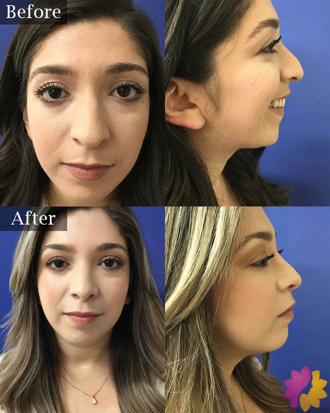 Precision Rhinoplasty Before