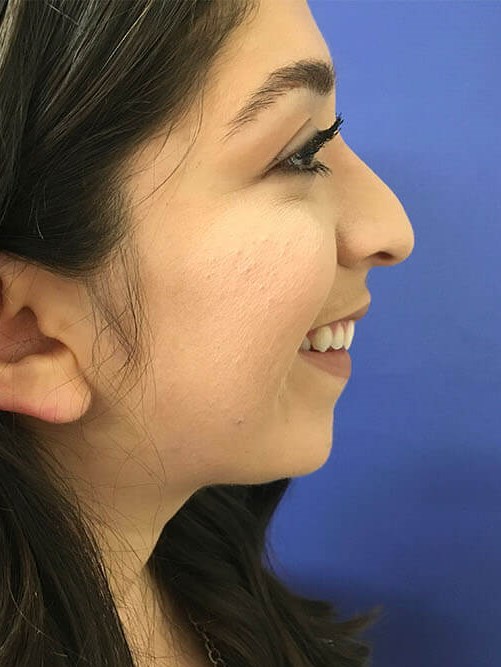 Precision Rhinoplasty Before