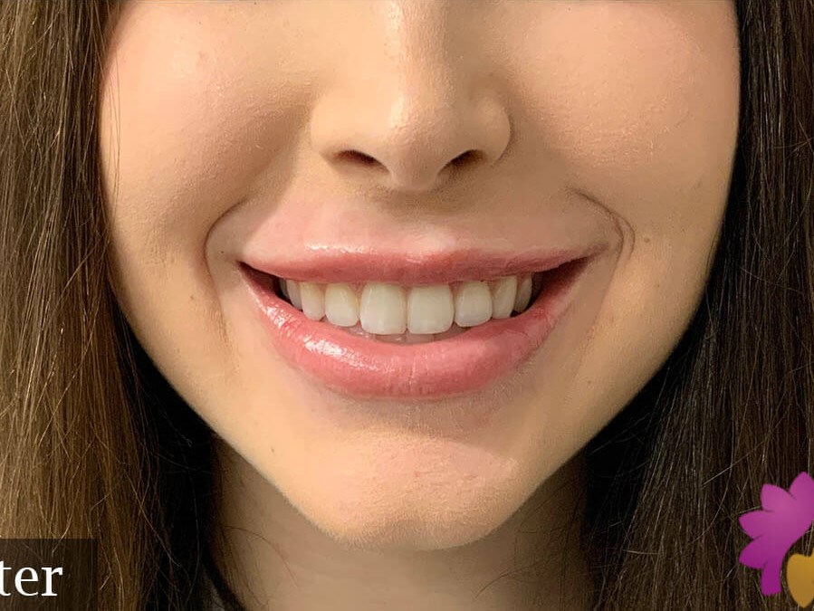 Restylane Kysse Lip Filler After
