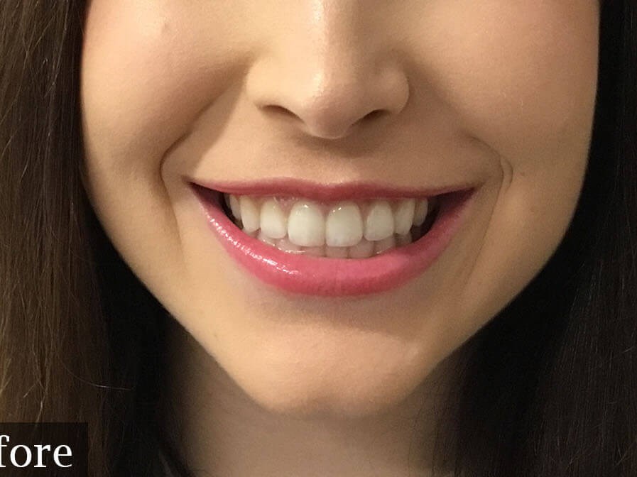 Restylane Kysse Lip Filler Before