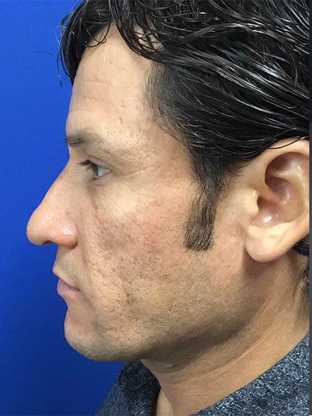 Precision Rhinoplasty Before