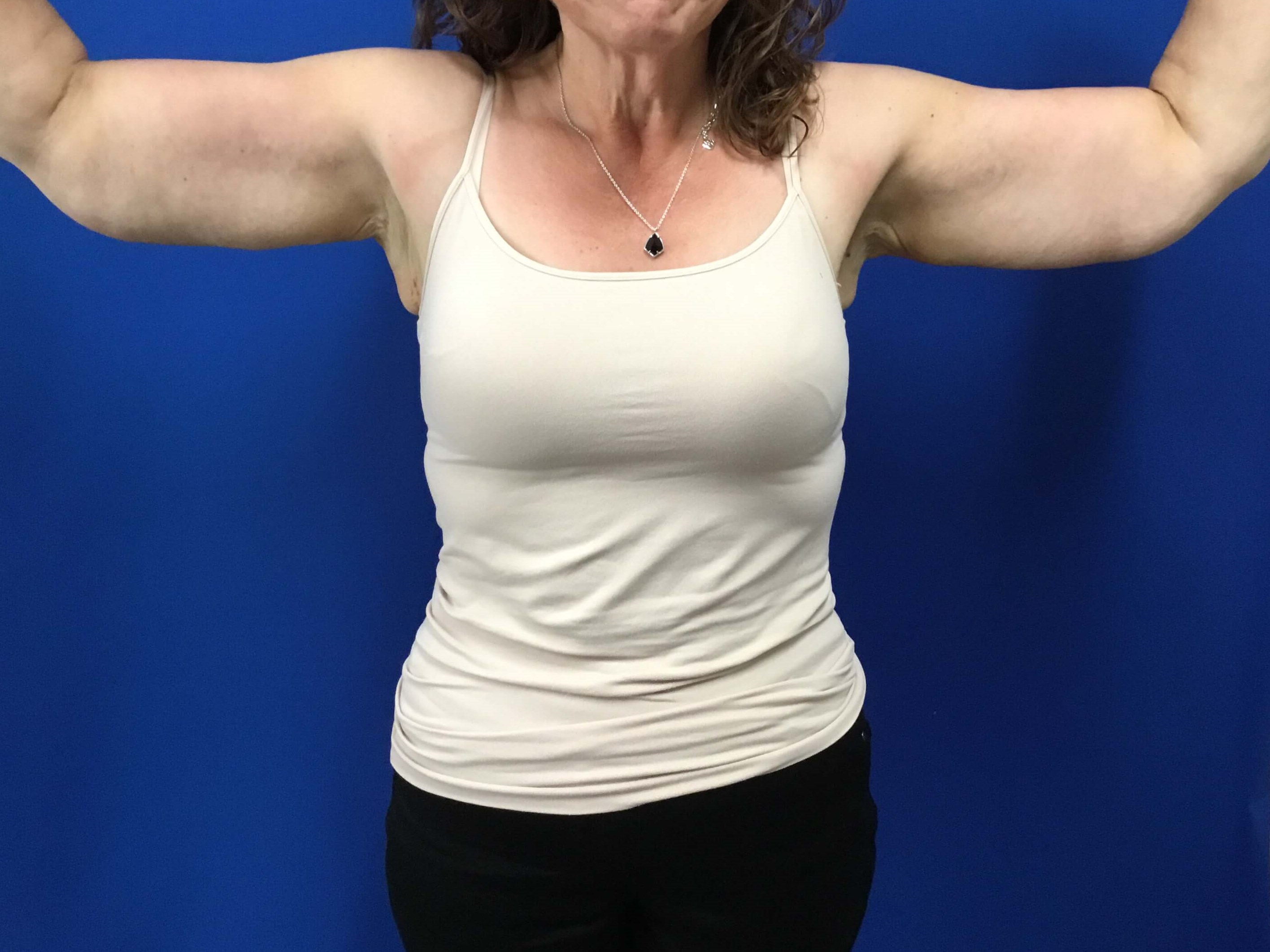 Front View-Brachioplasty After