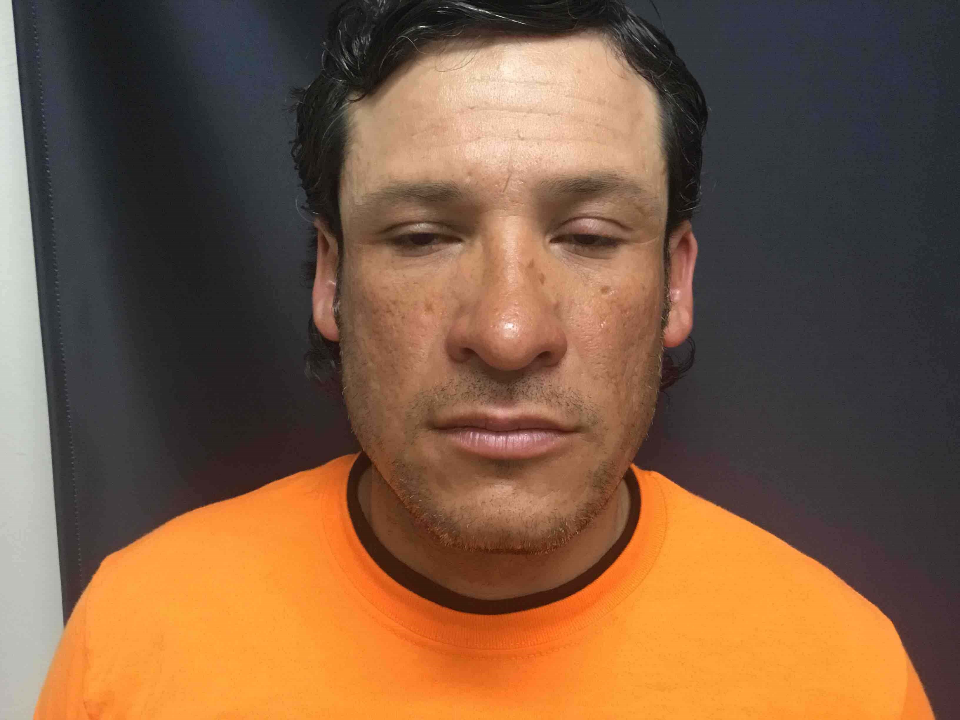 Precision Rhinoplasty After