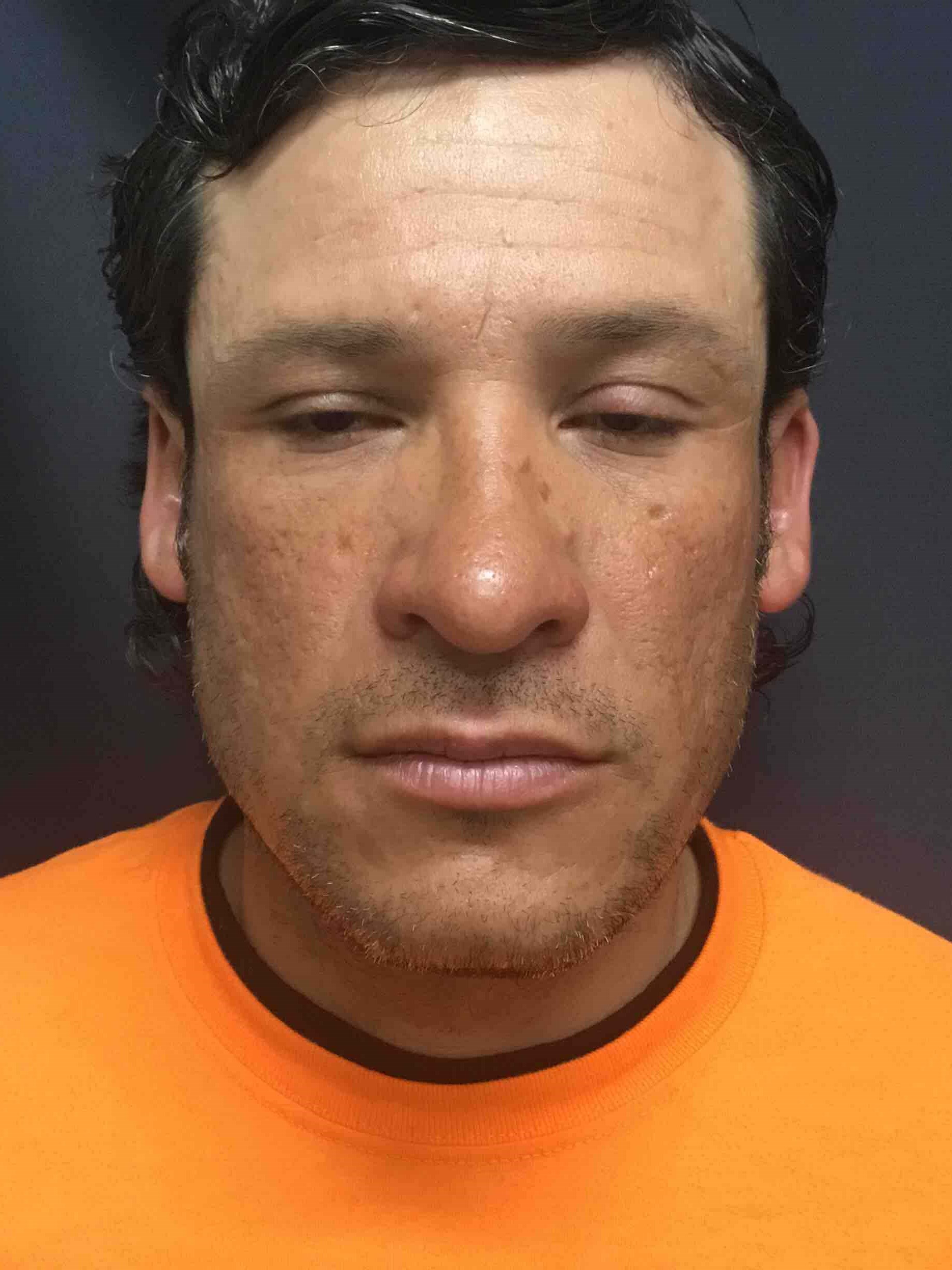 Precision Rhinoplasty After