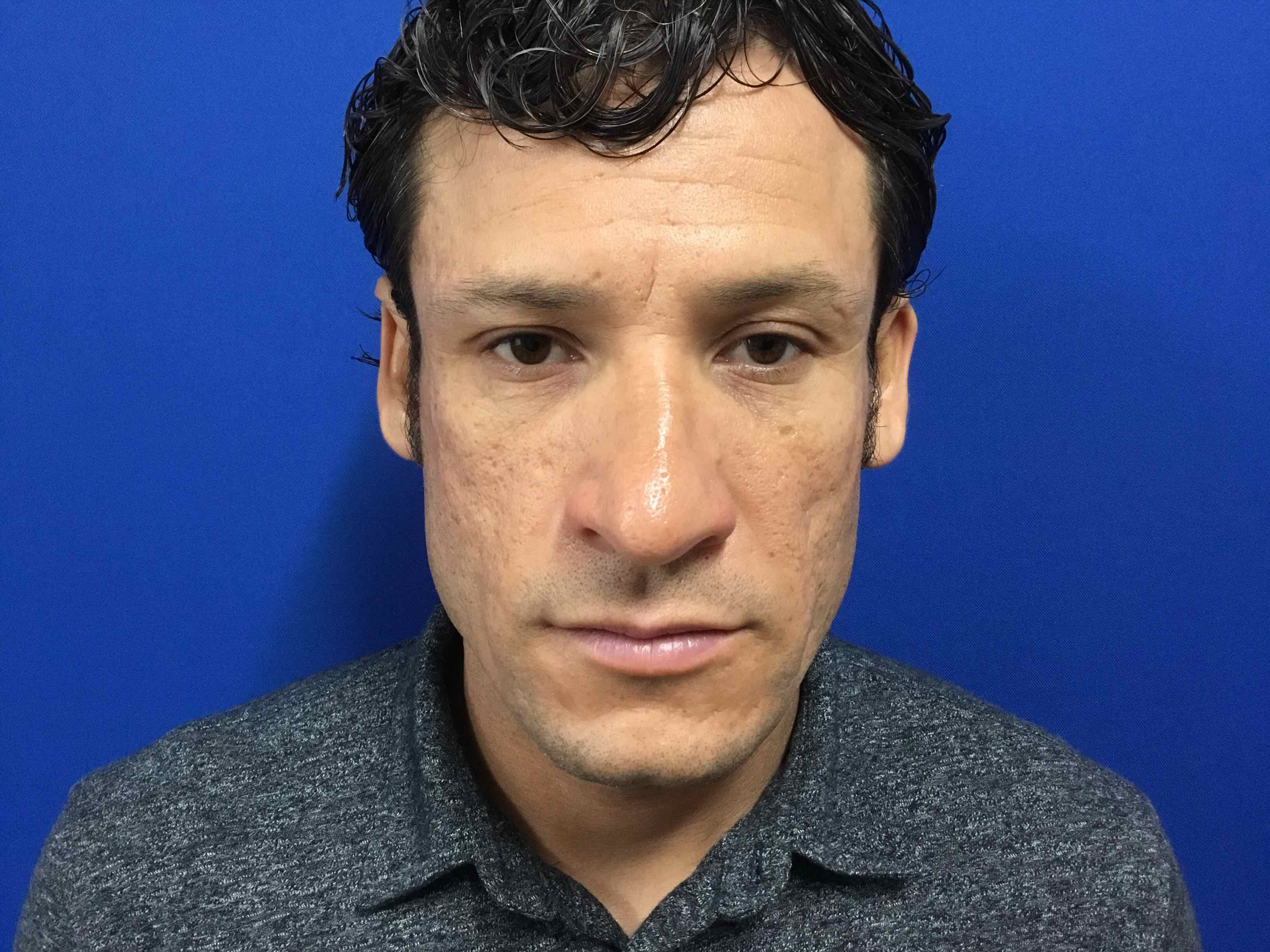 Precision Rhinoplasty Before