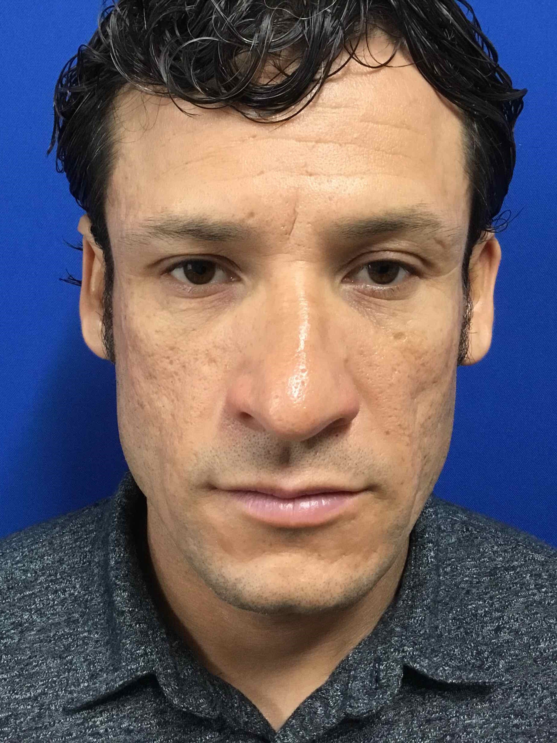 Precision Rhinoplasty Before