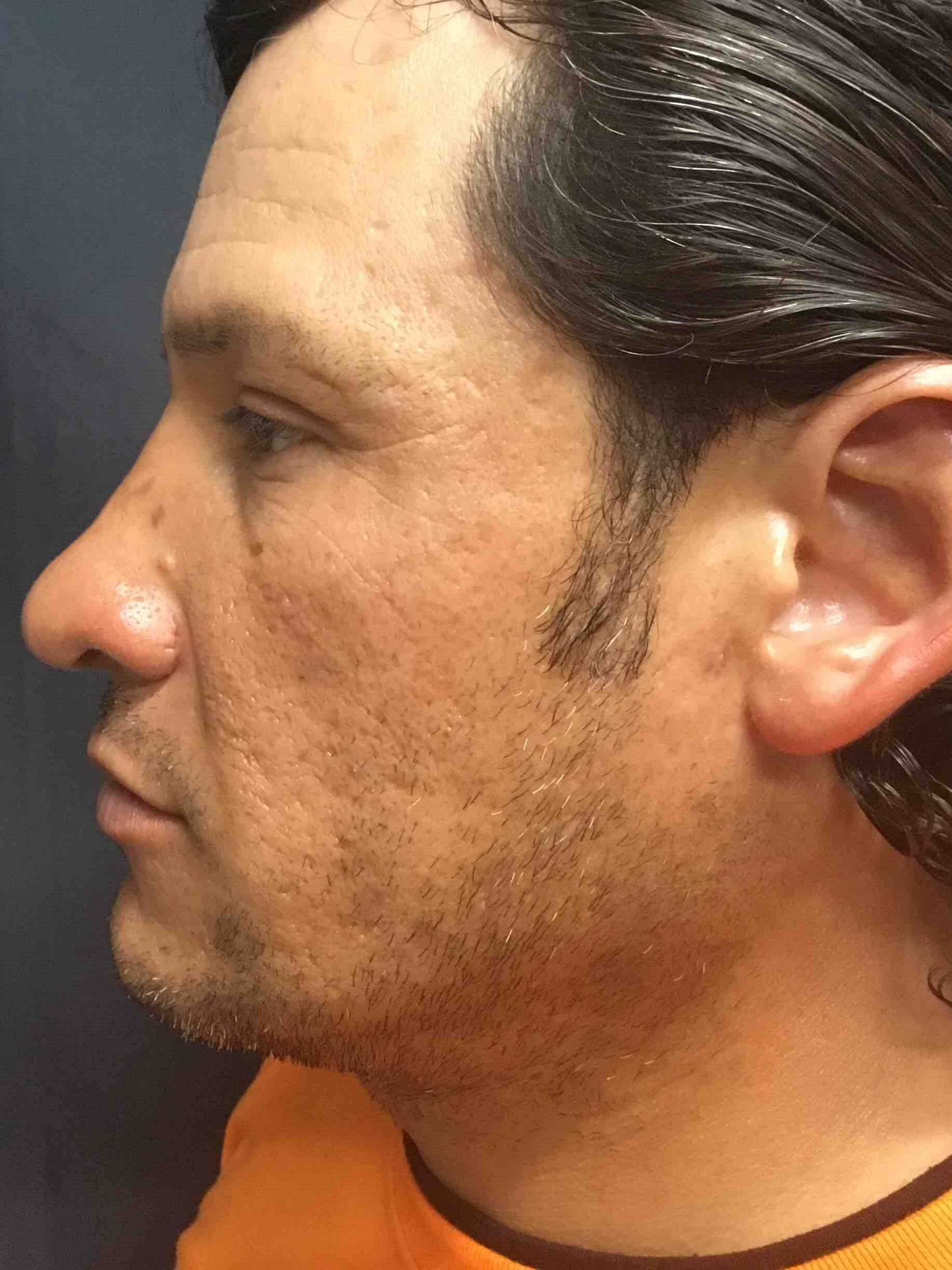 Precision Rhinoplasty After
