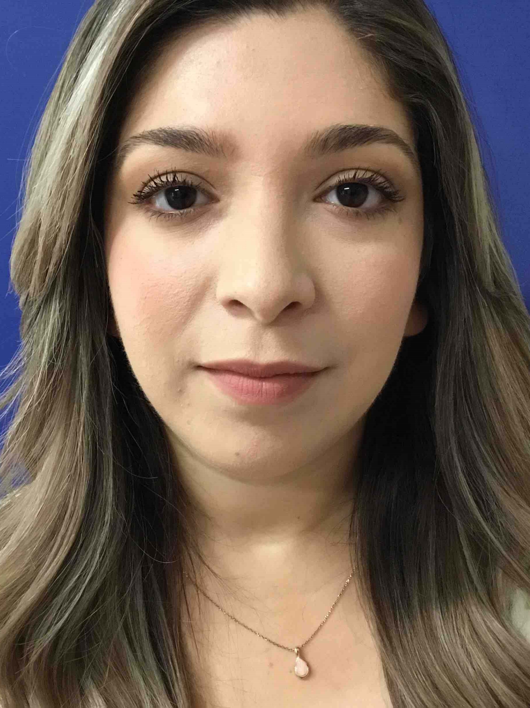 precision Rhinoplasty After