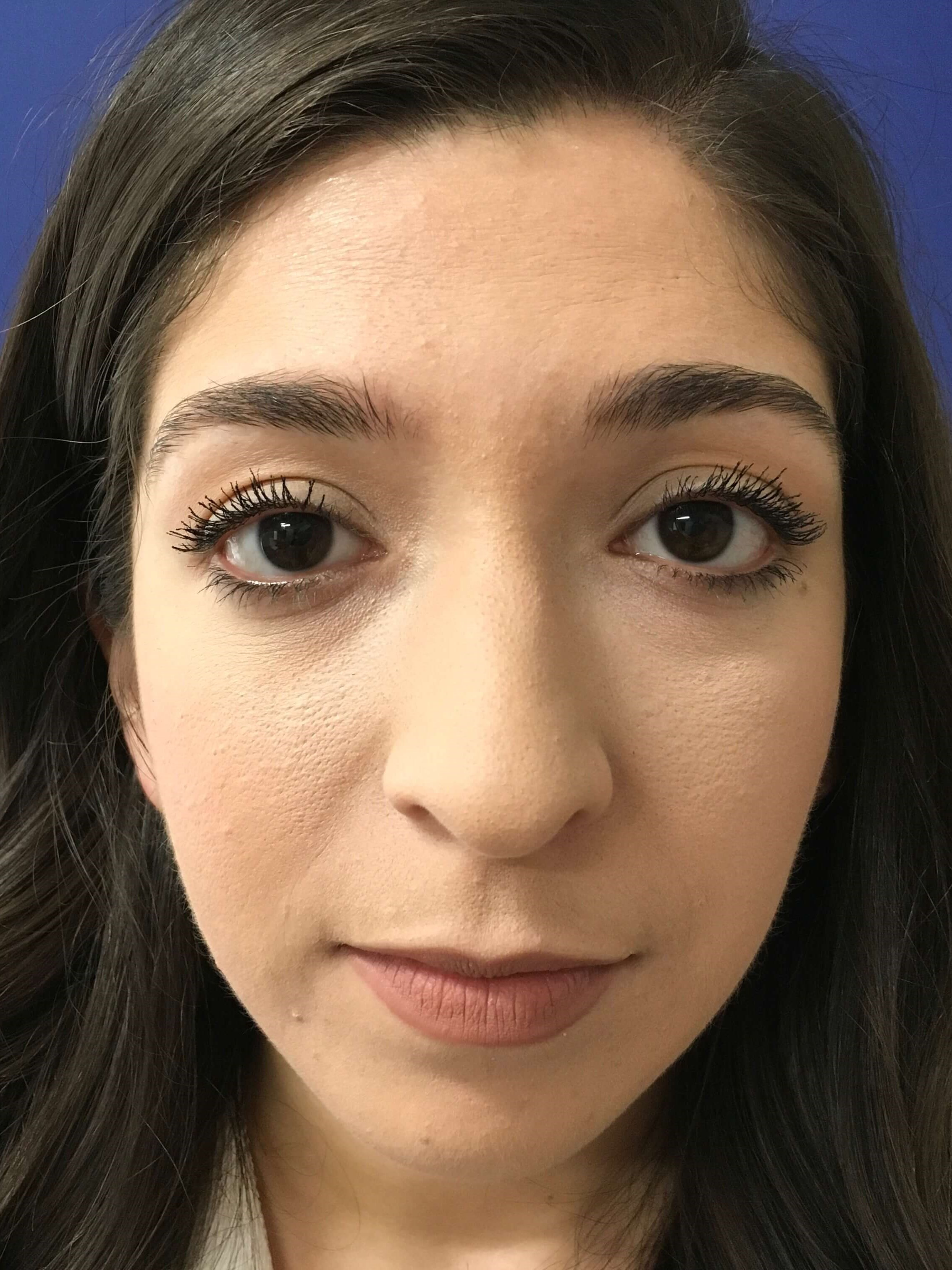 precision Rhinoplasty Before