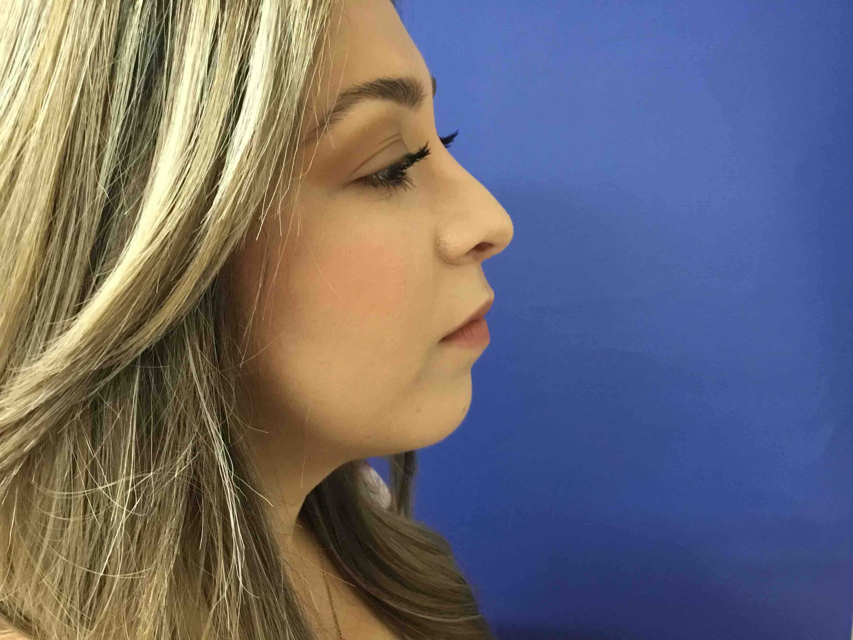 Precision Rhinoplasty After