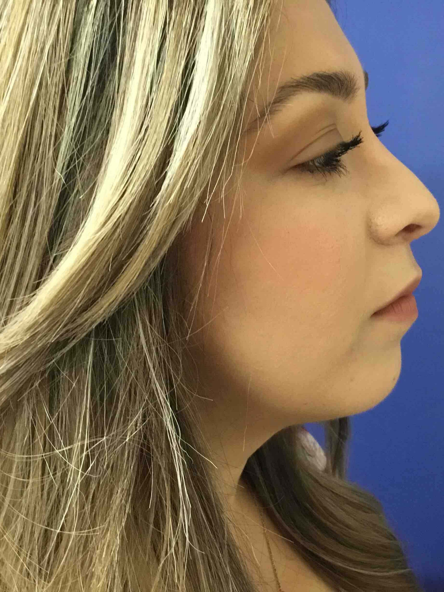 Precision Rhinoplasty After