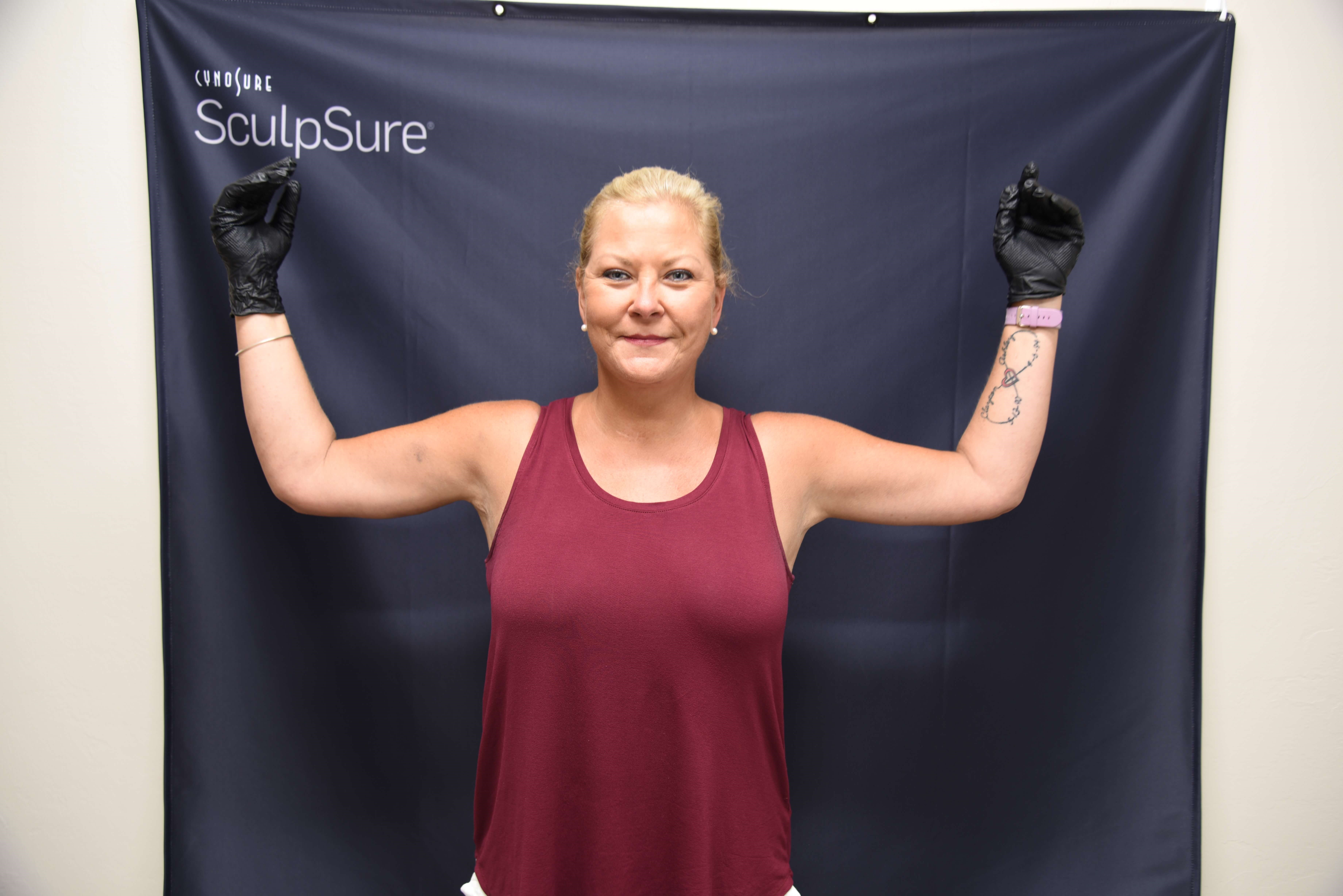 Front View-Brachioplasty After