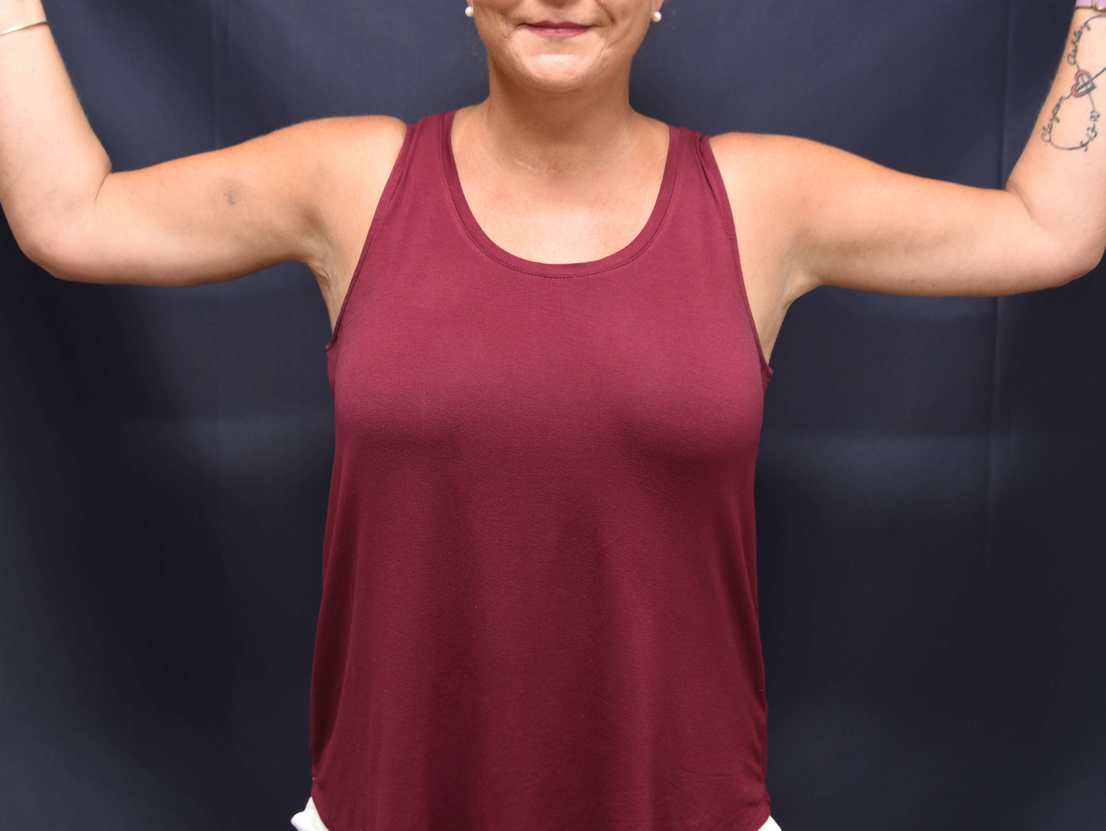 Front View-Brachioplasty After