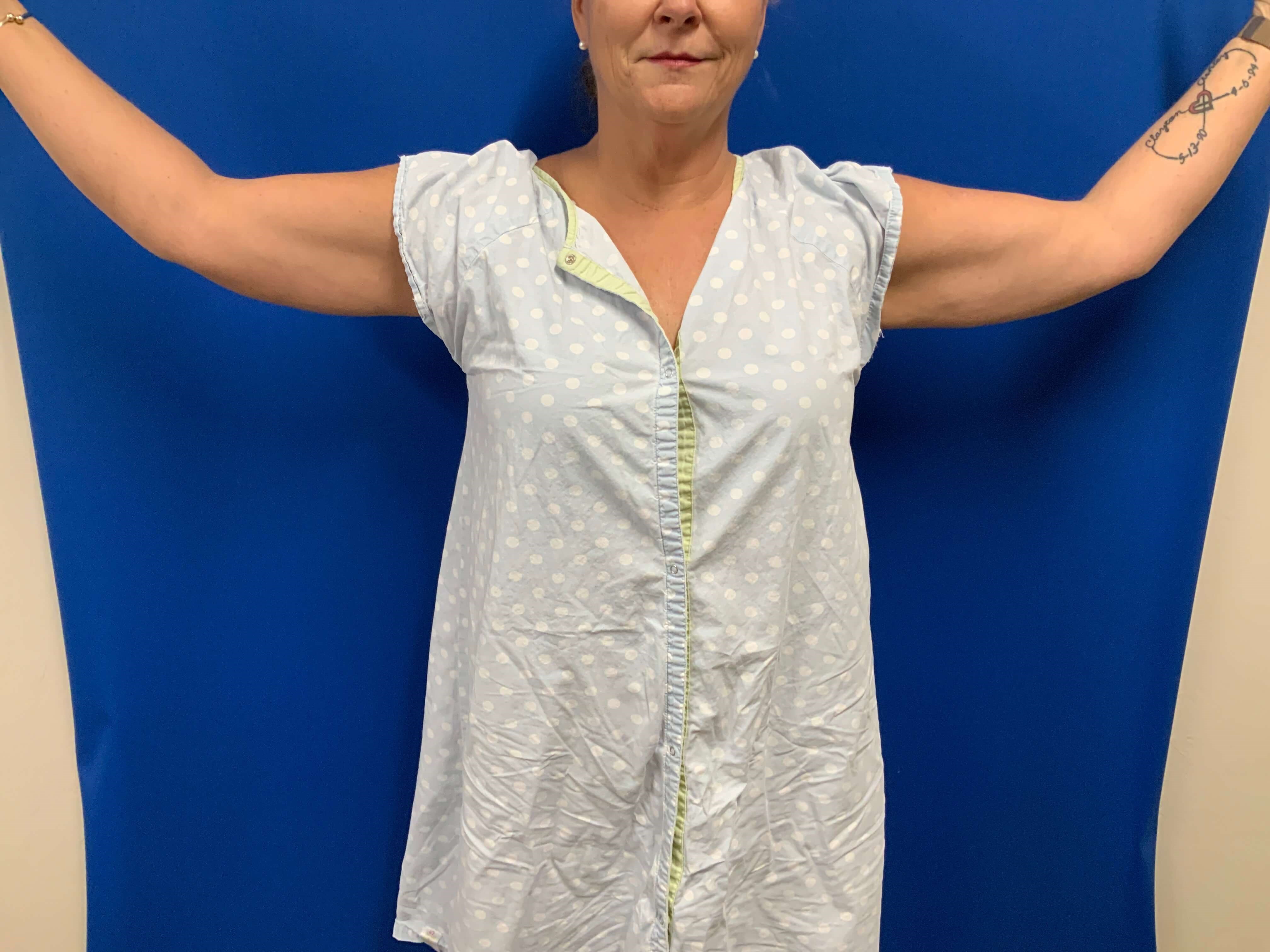 Front View-Brachioplasty Before