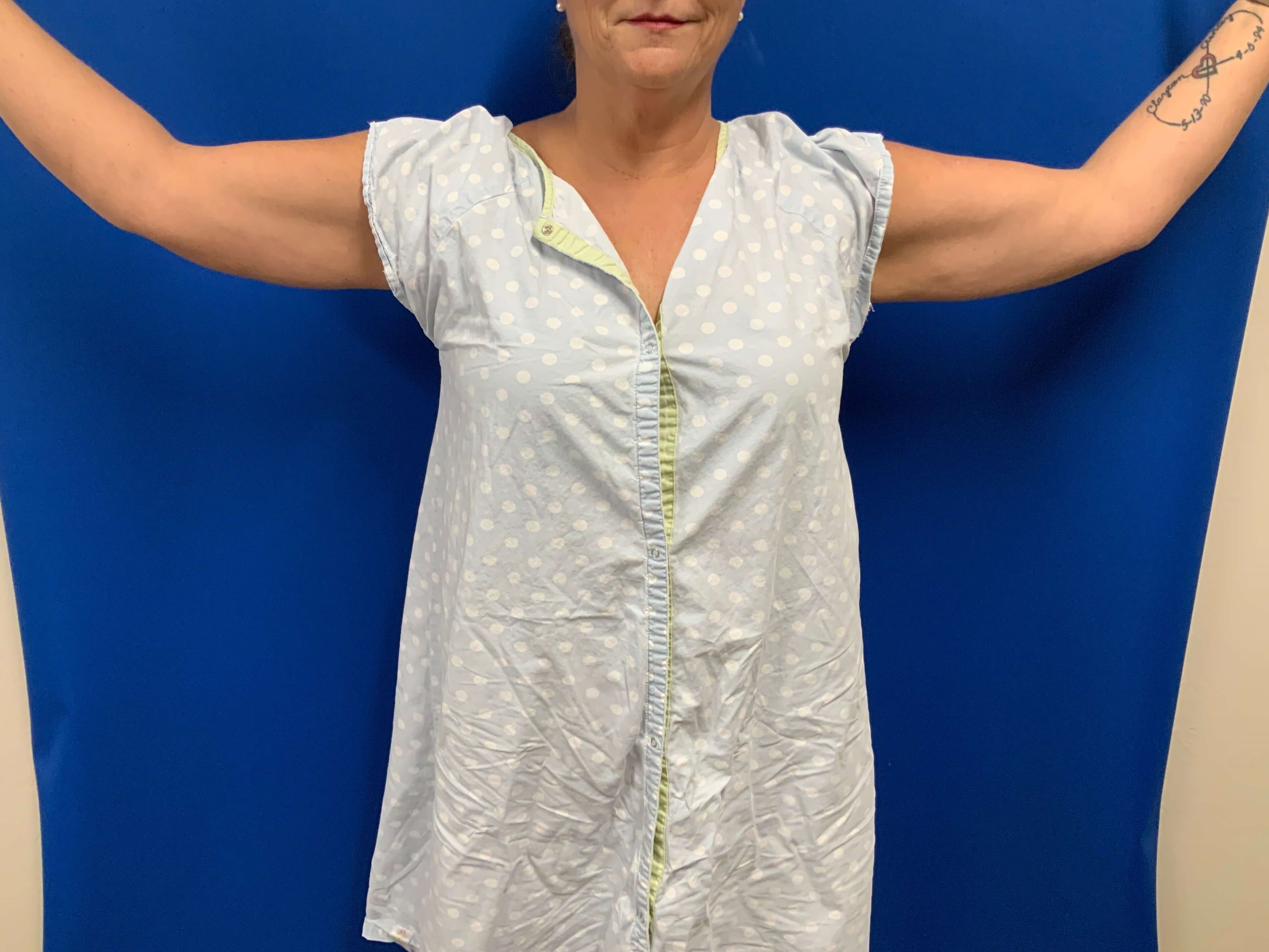 Front View-Brachioplasty Before