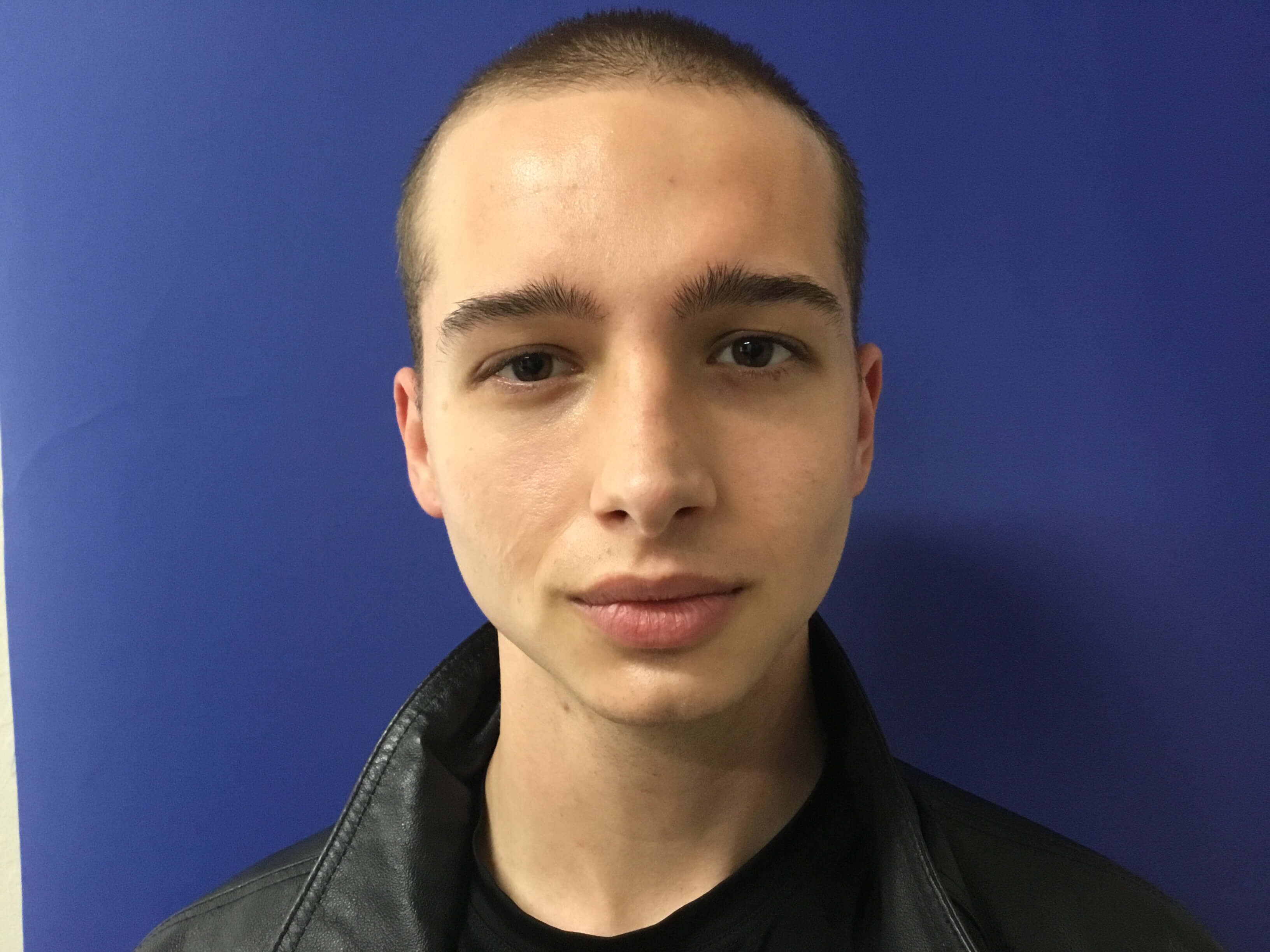 Buccal fat removal After