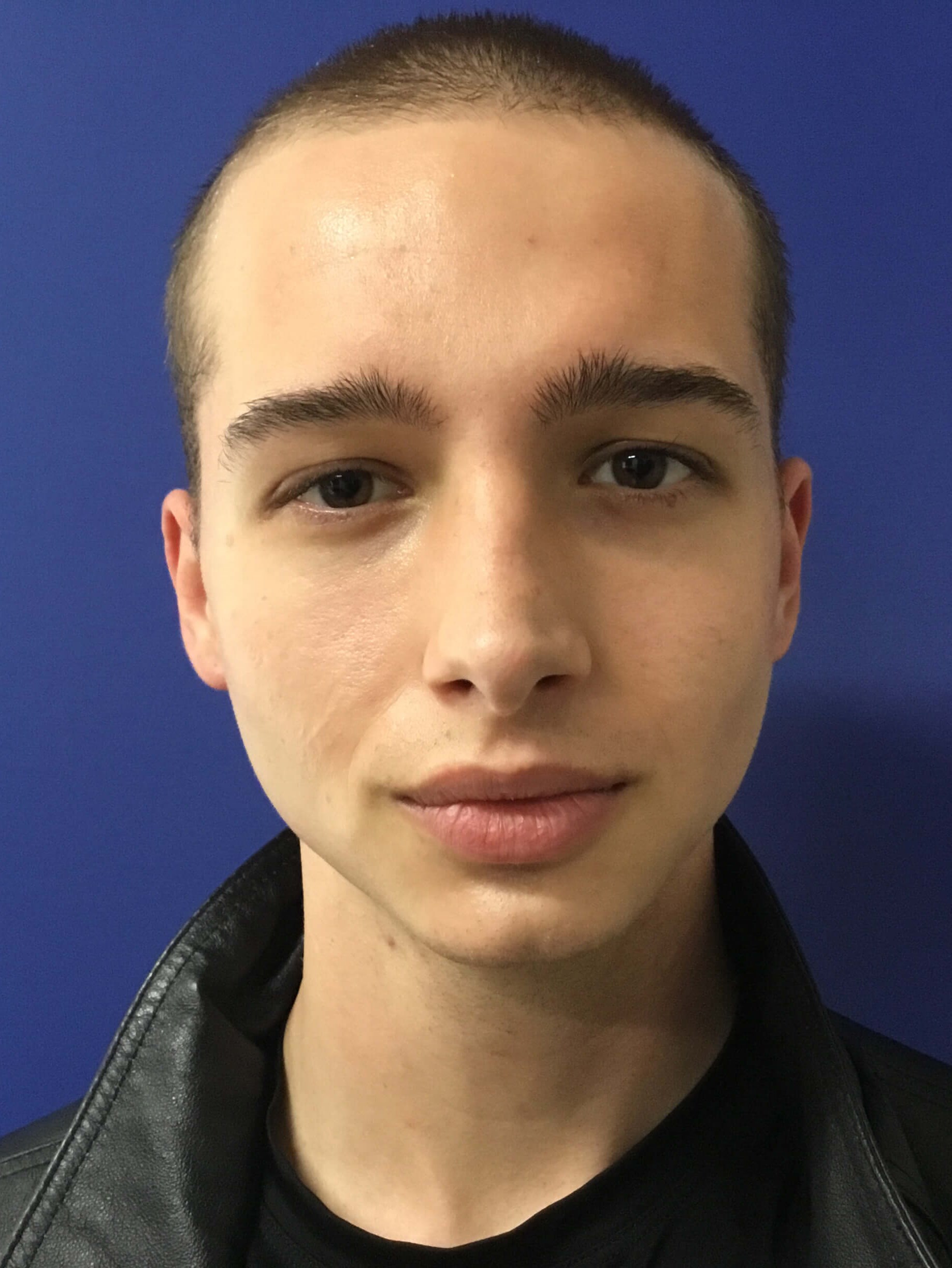 Buccal fat removal After