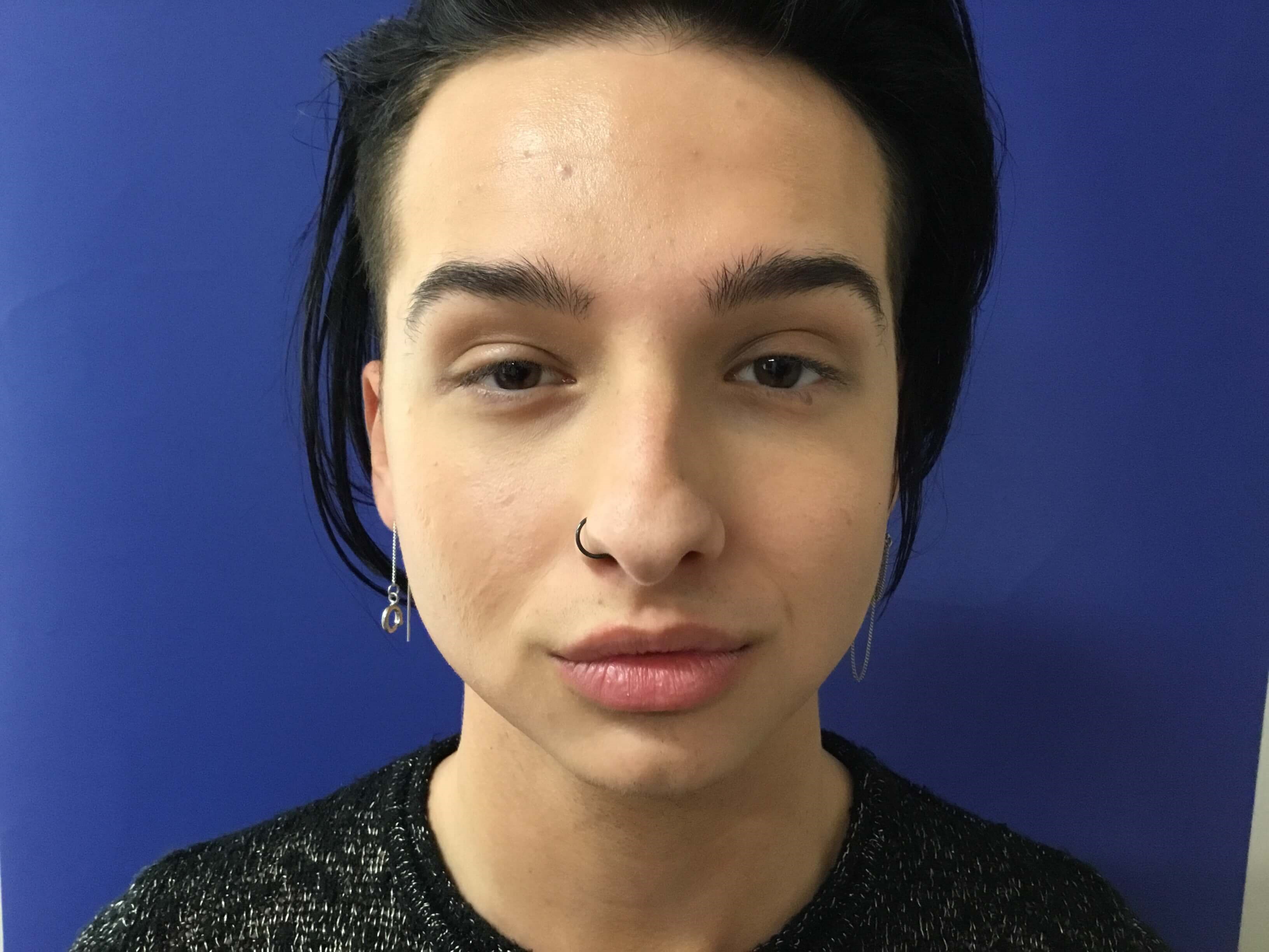 Buccal fat removal Before