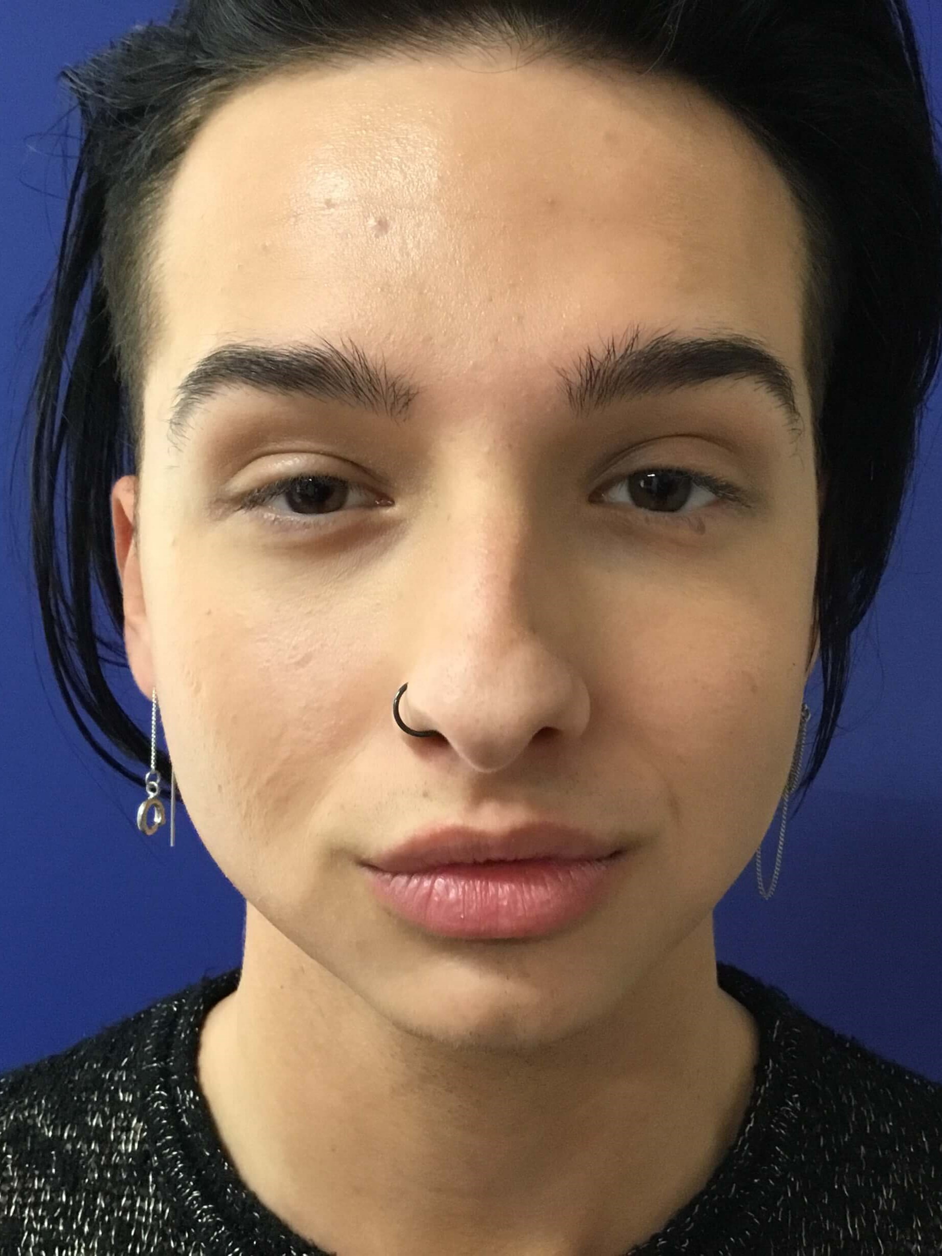 Buccal fat removal Before