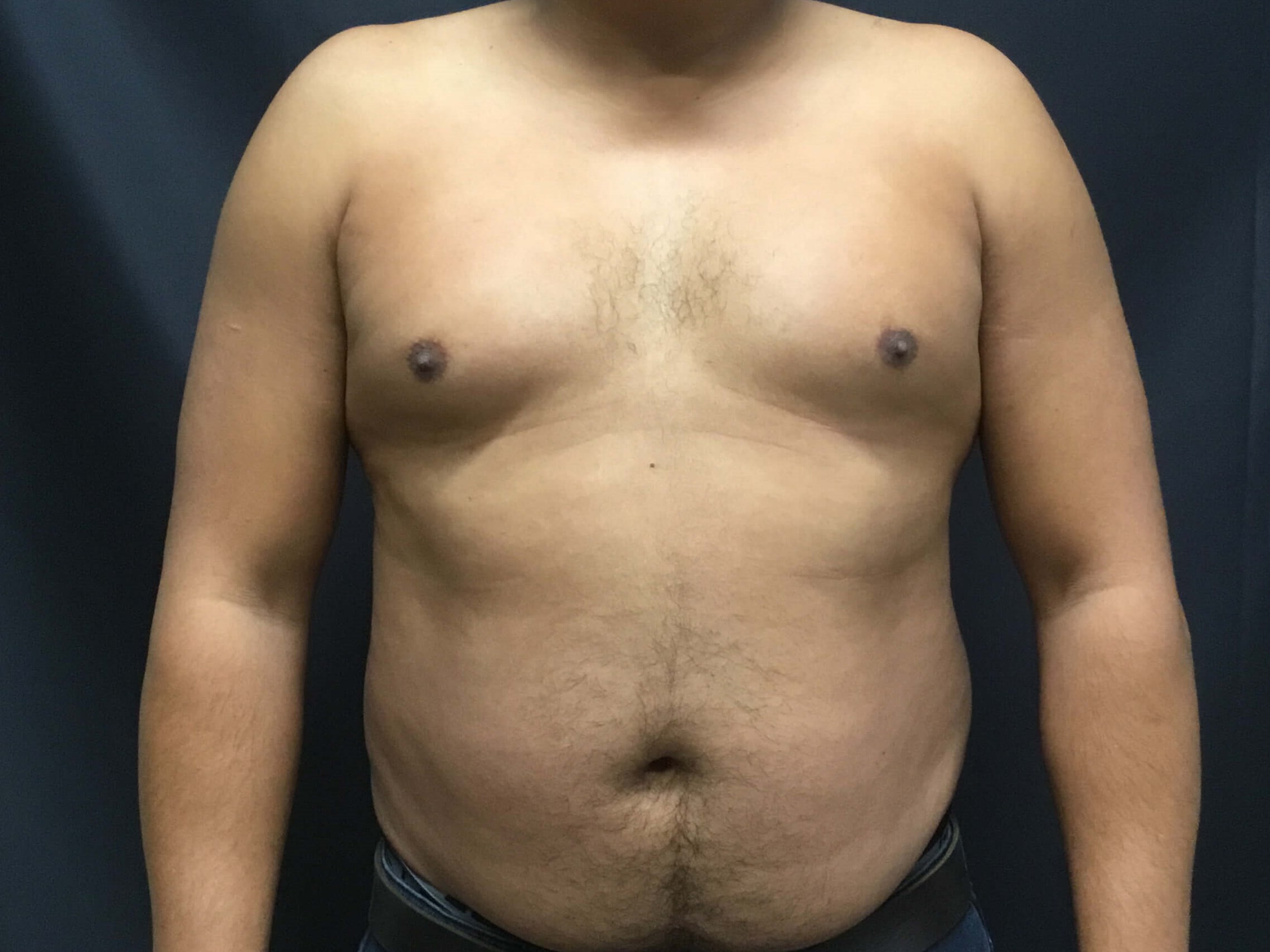 HD Vaser Liposuction Before