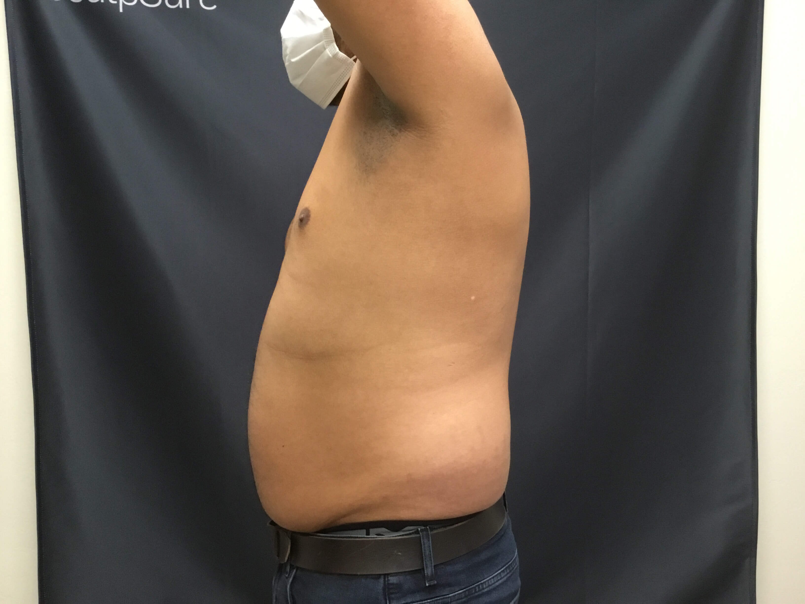 HD Vaser Liposuction Before