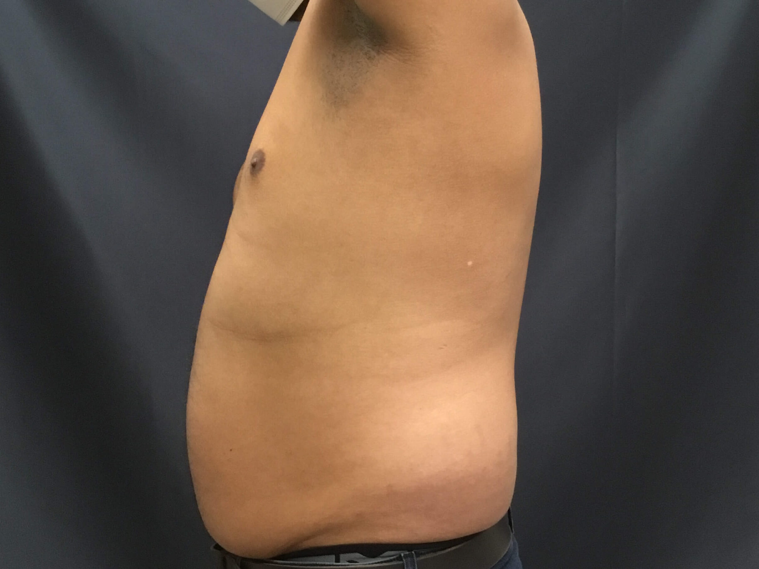 HD Vaser Liposuction Before