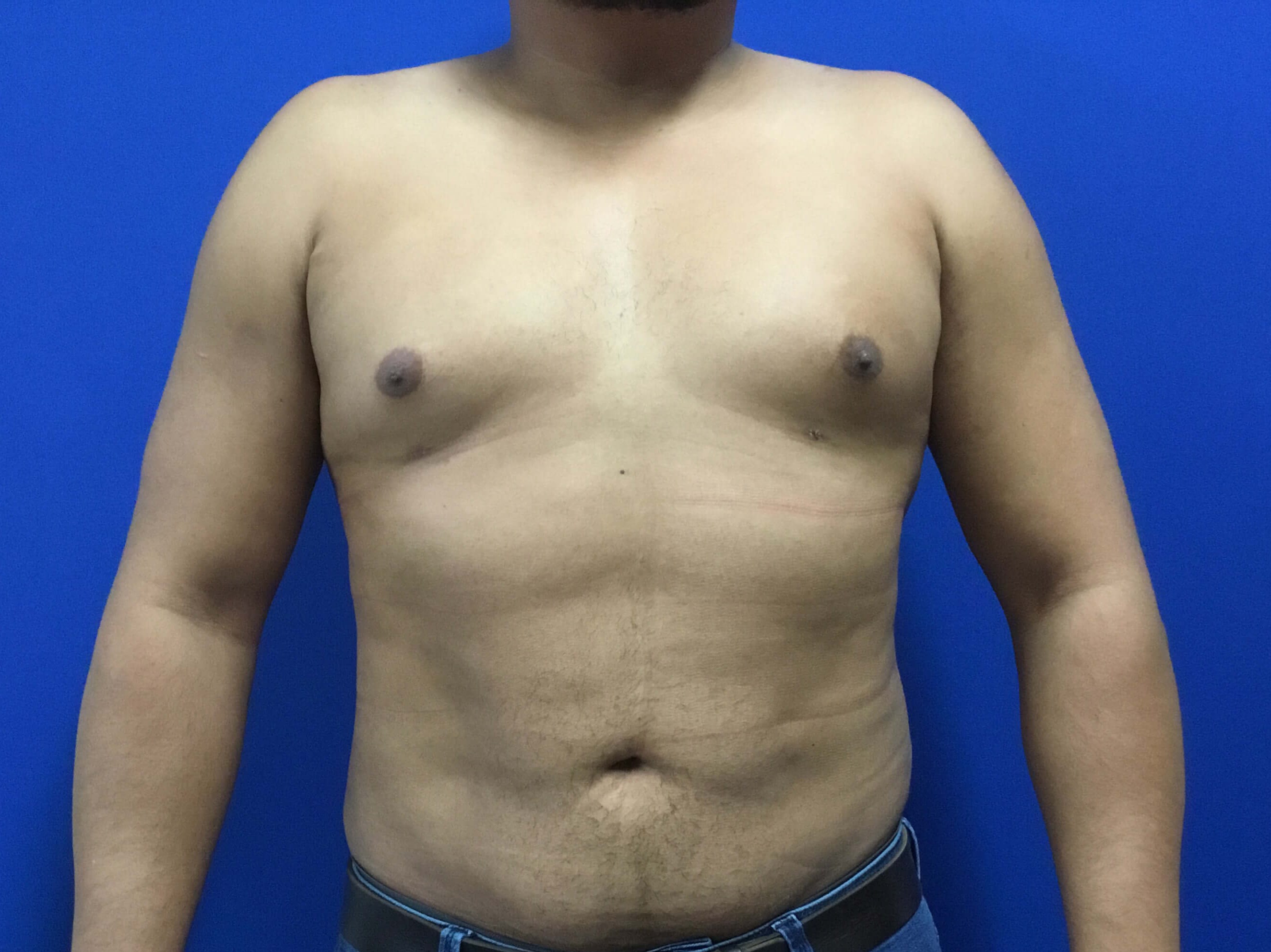 HD Vaser Liposuction After