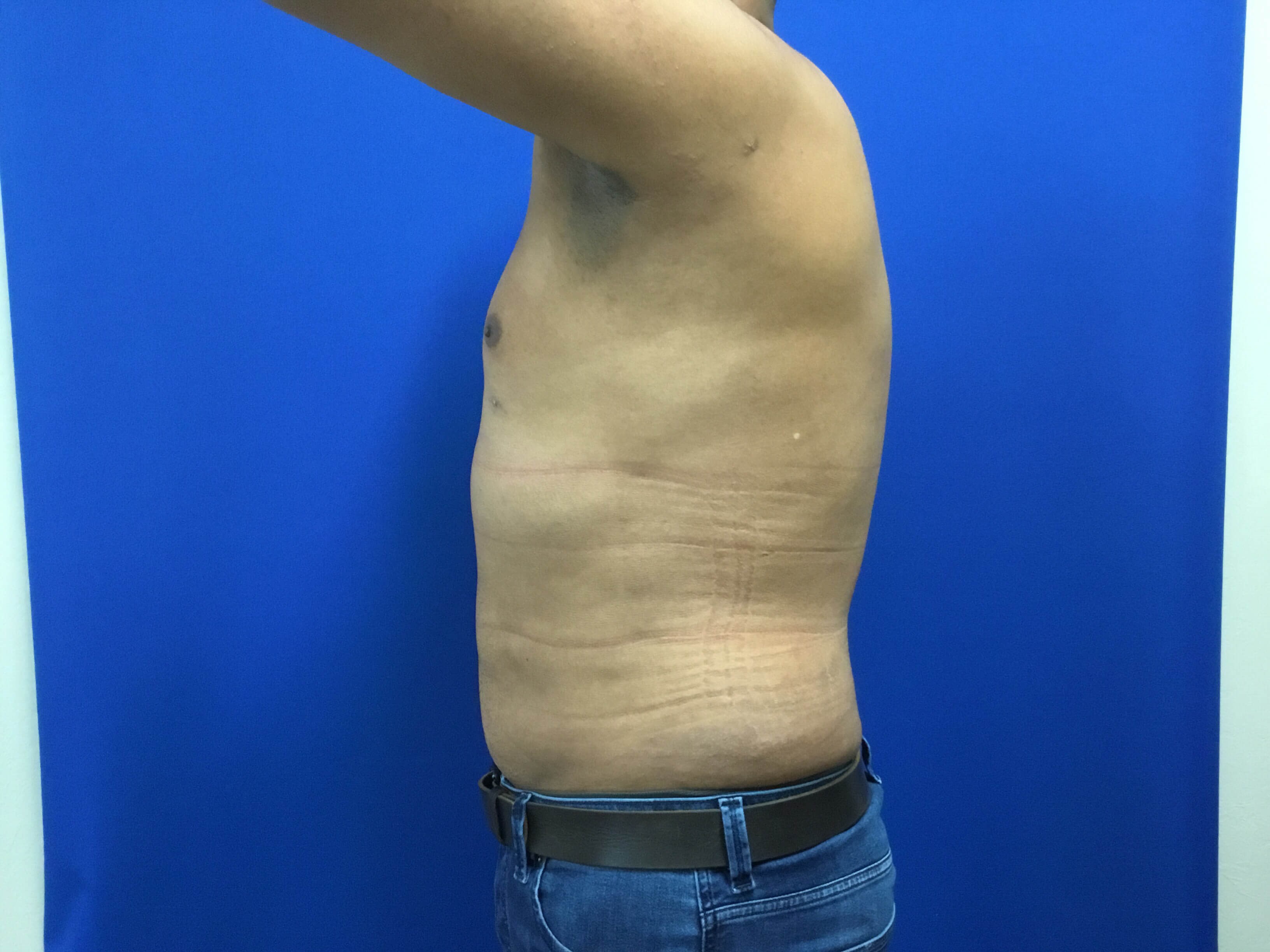 HD Vaser Liposuction After
