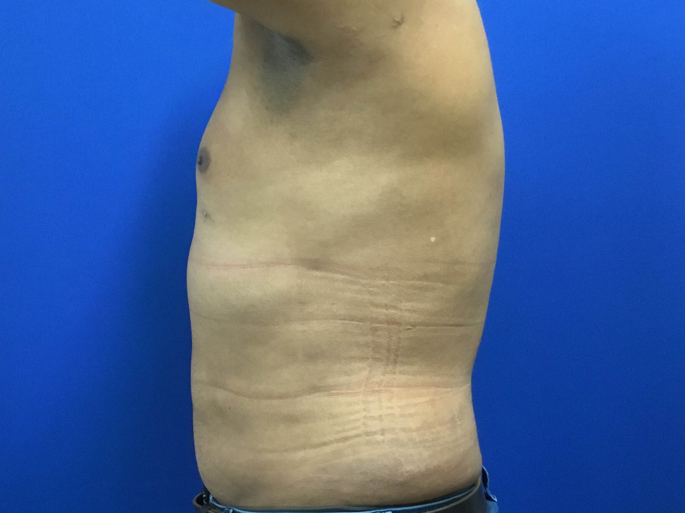 HD Vaser Liposuction After